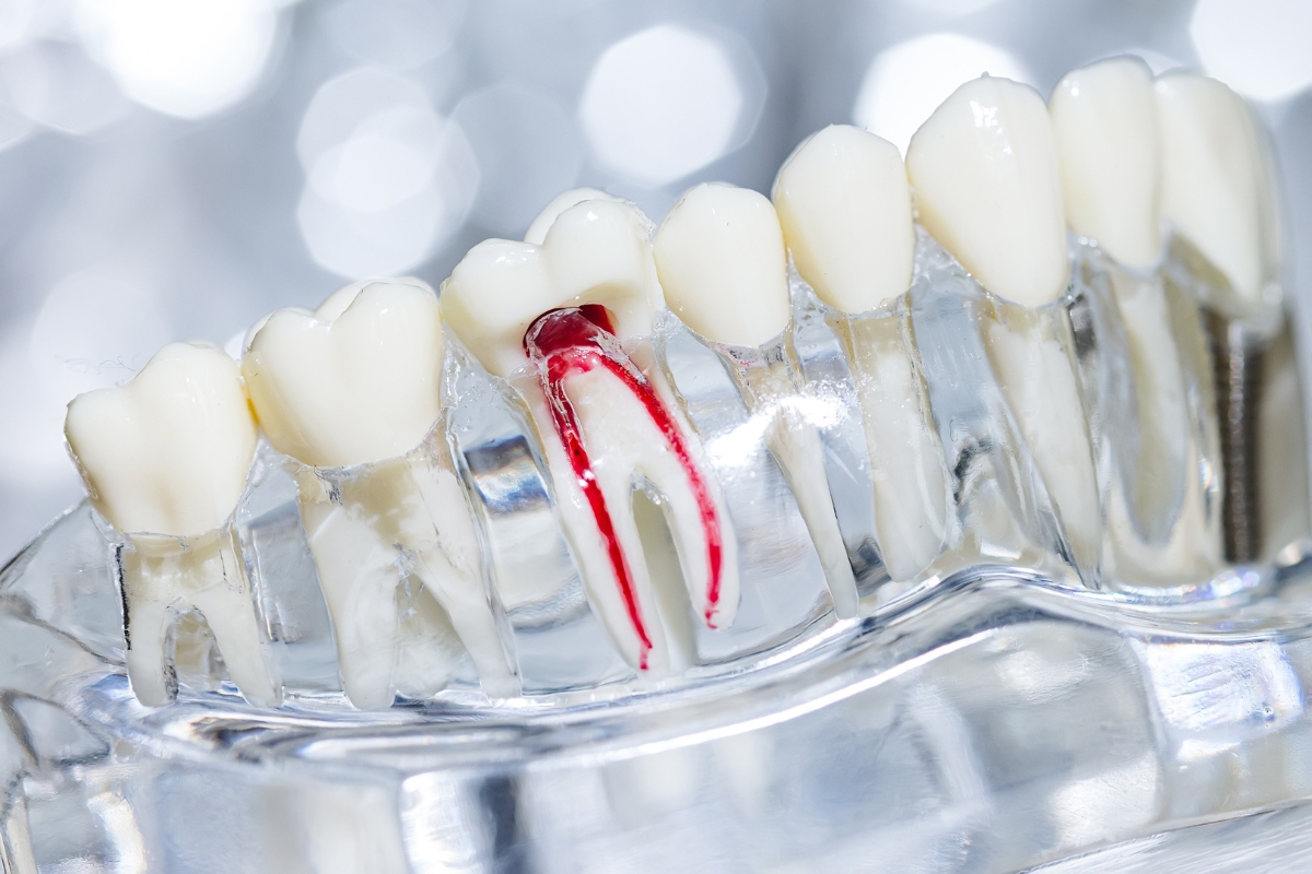 Illustrated cross section of a tooth showing root canal anatomy with dental instruments