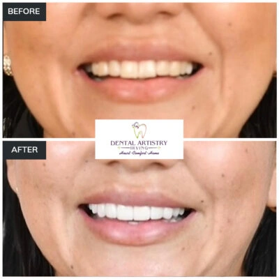 Before and after comparison showing treatment results at Dental Artistry Irving