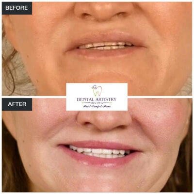 Before and after comparison showing treatment results at Dental Artistry Irving
