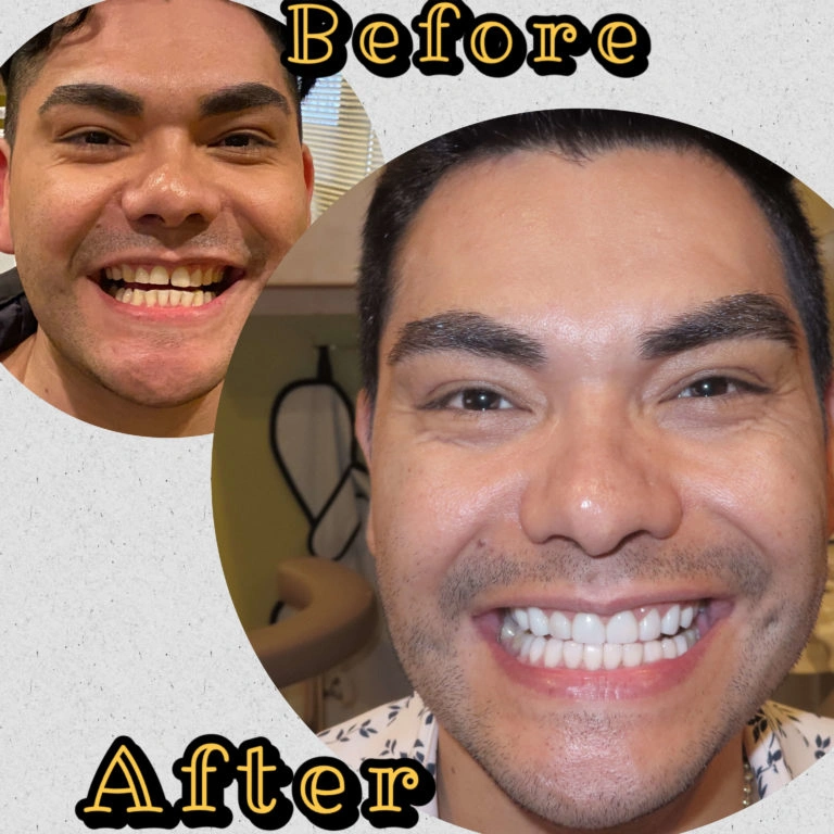Before and after comparison showing treatment results at Dental Artistry Irving