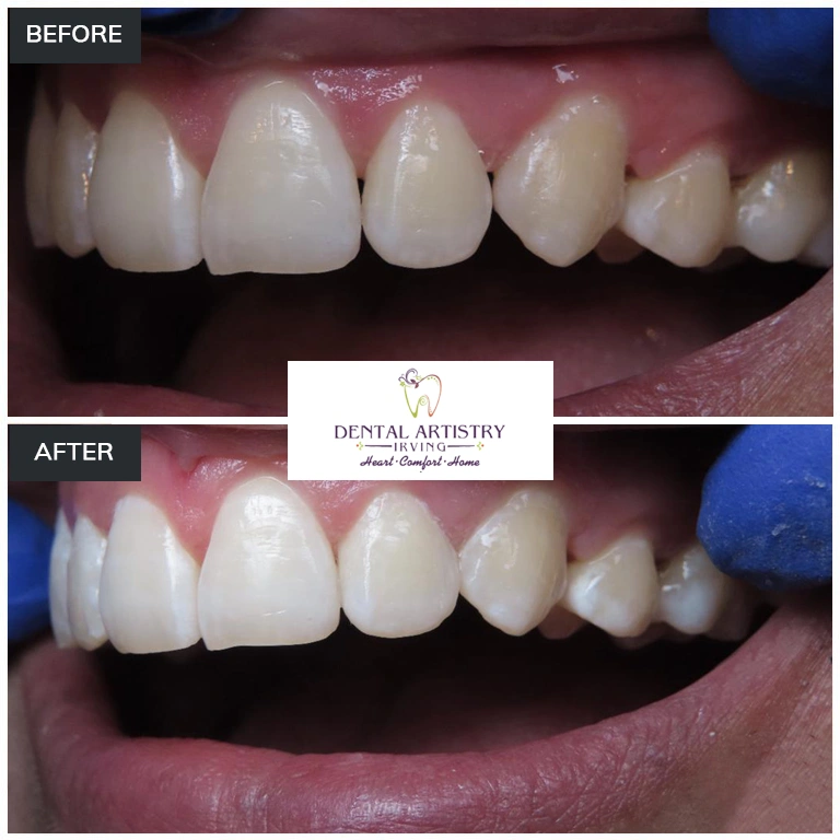 Before and after comparison showing treatment results at Dental Artistry Irving