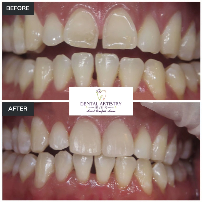 Before and after comparison showing treatment results at Dental Artistry Irving