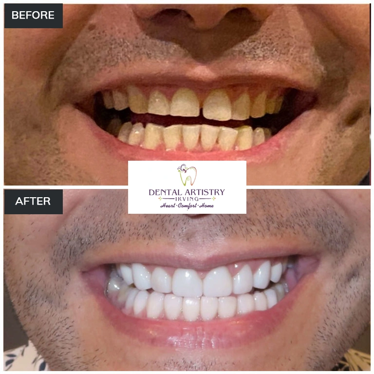 Before and after comparison showing treatment results at Dental Artistry Irving