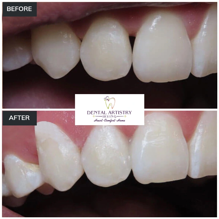 Before and after comparison showing treatment results at Dental Artistry Irving