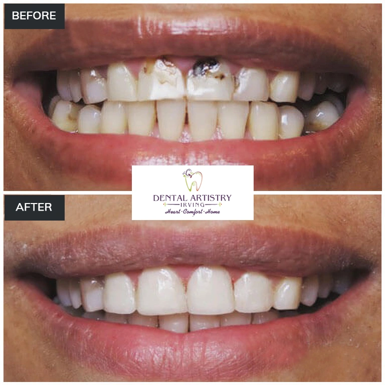 Before and after comparison showing treatment results at Dental Artistry Irving