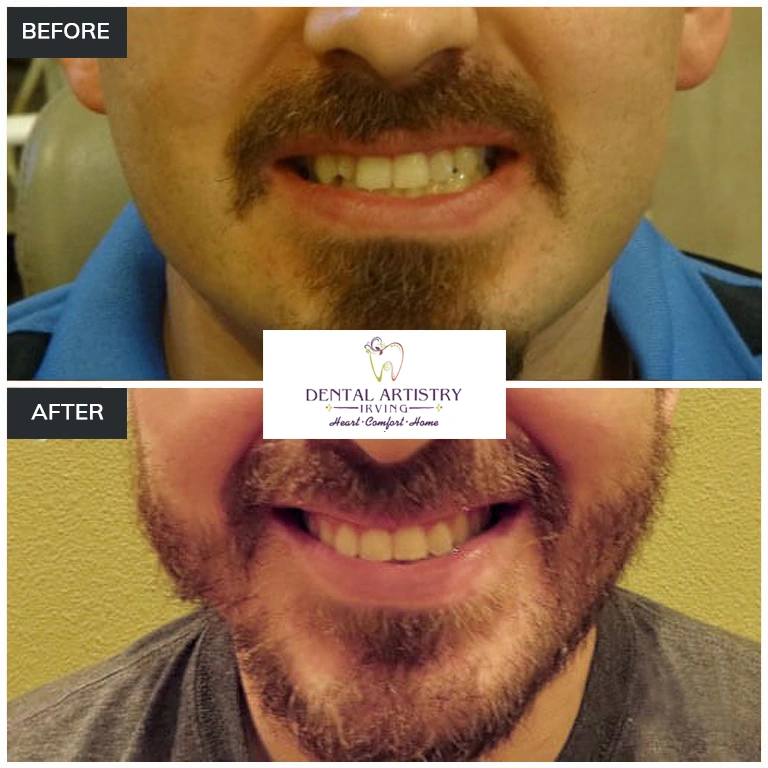 Before and after comparison showing treatment results at Dental Artistry Irving
