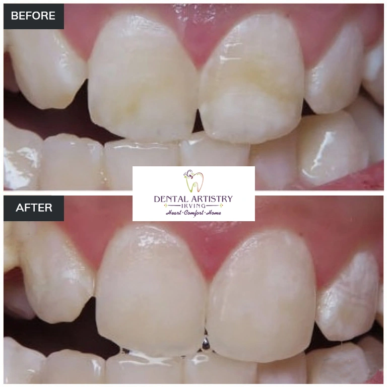 Before and after comparison showing treatment results at Dental Artistry Irving