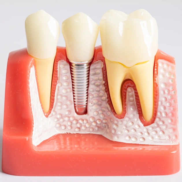 Physical dental model showing a titanium implant post placed in the jawbone with surrounding teeth and bone structure