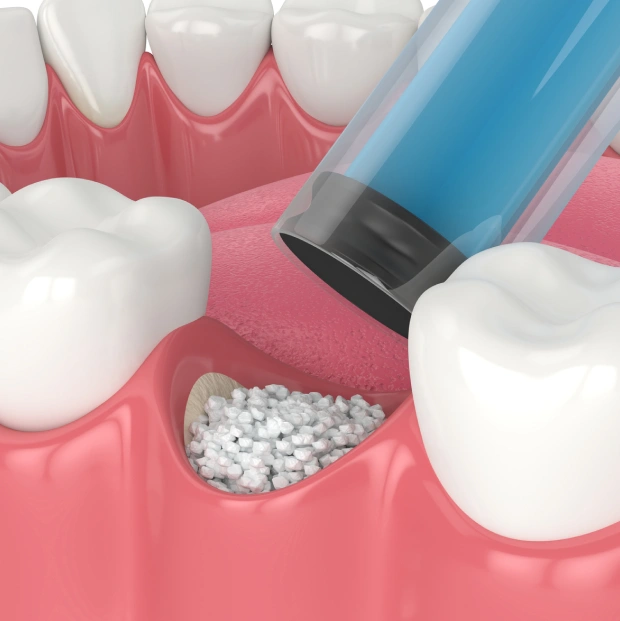 3D illustration of bone graft material being placed into a tooth socket in the jaw during a bone augmentation procedure