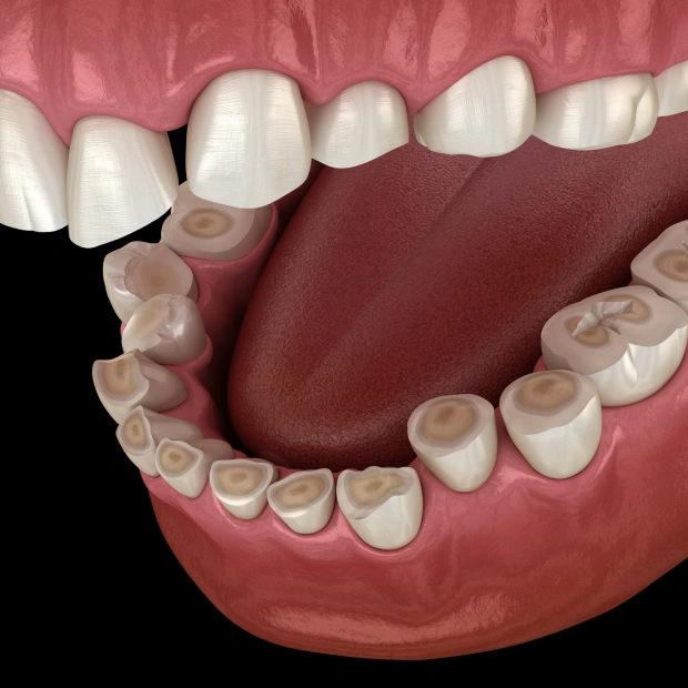 3D illustration of worn and flattened teeth caused by bruxism or teeth grinding