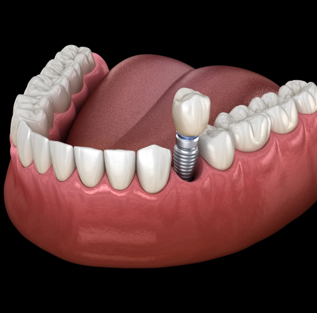 3D illustration of a dental implant placed in a lower jaw model on a dark background