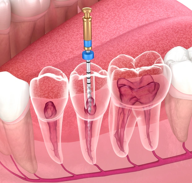 3D illustration of a dental implant or root canal procedure showing the tooth structure and surrounding gum tissue