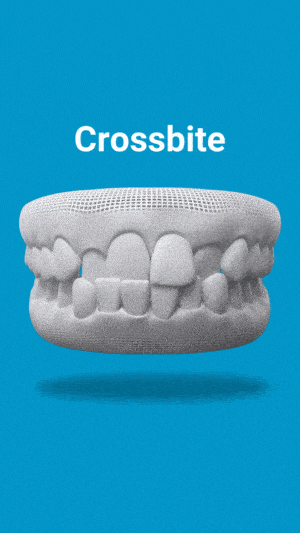 3D dental model graphic labeled Crossbite on a blue background