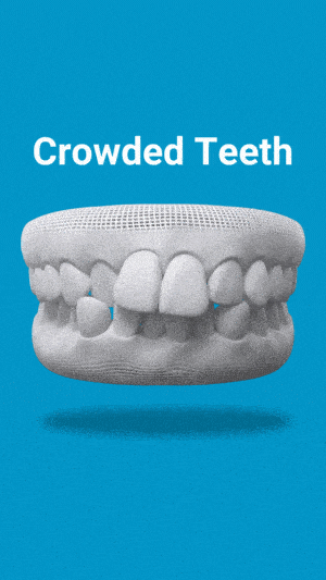 3D dental model graphic labeled Crowded Teeth on a blue background