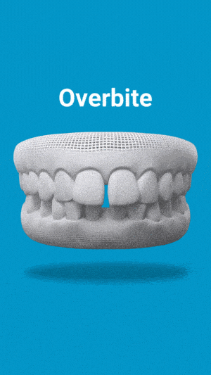 3D dental model graphic labeled Overbite on a blue background