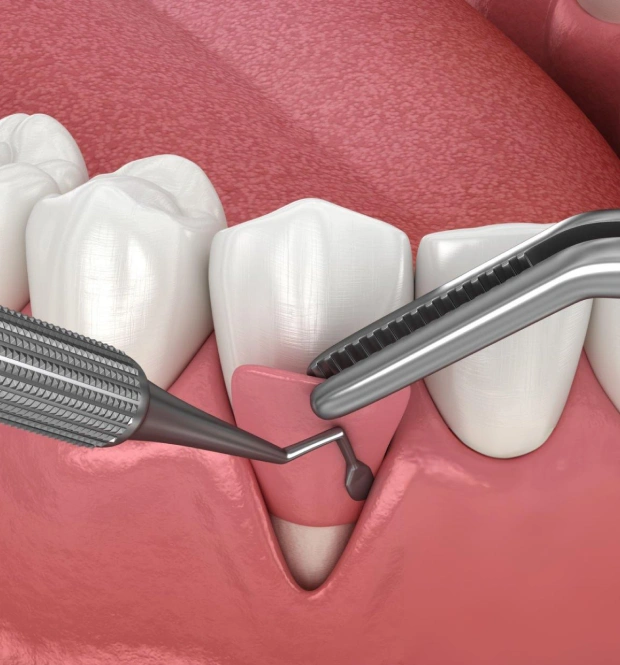 3D illustration of surgical instruments performing a gingival graft procedure on receding gum tissue around a tooth
