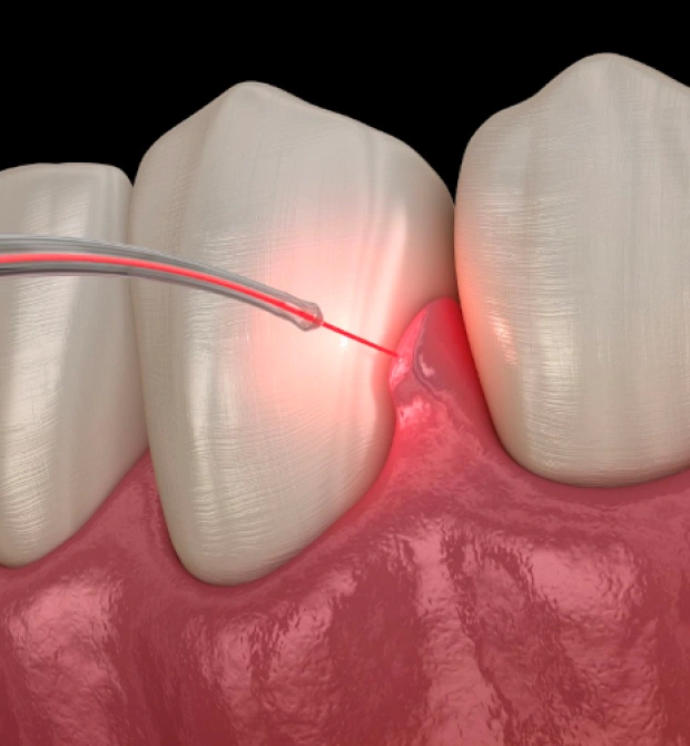 Ilustración 3D de un láser siendo utilizado en tejido gingival inflamado entre los dientes.