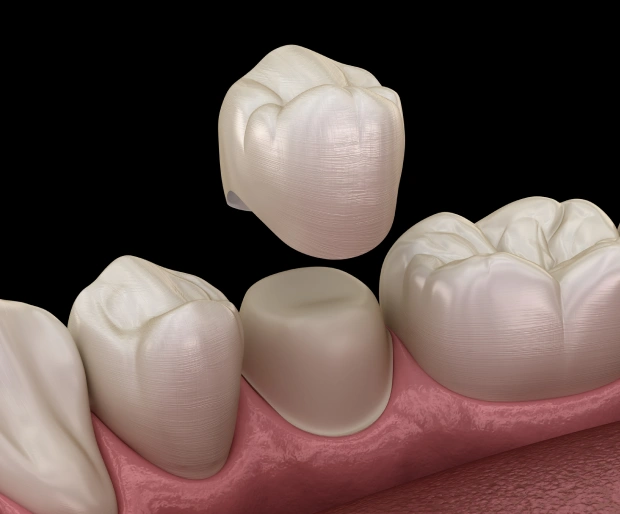 3D illustration of two ceramic dental crowns on a white surface