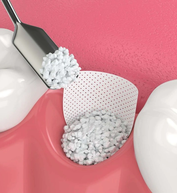 3D illustration of bone graft granules and a membrane being placed into a tooth socket during a socket preservation procedure