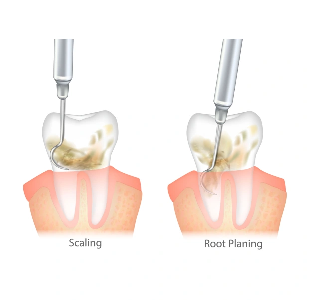 Illustrated diagram showing the steps of dental scaling and root planing