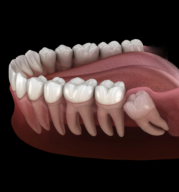3D illustration of a lower jaw with teeth showing a dental implant on a dark background
