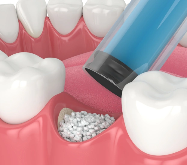 3D illustration of bone graft material being placed near a tooth during a procedure