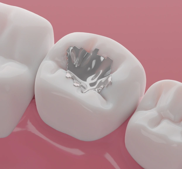 Close up of composite filling on a pink surface