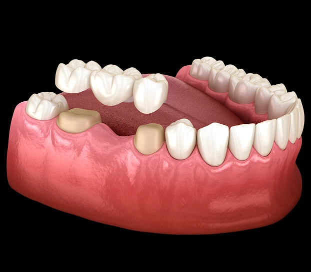 3D dental model showing a full set of lower teeth in a pink gum base