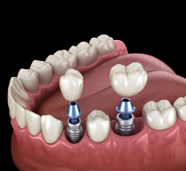 Ilustración 3D de implantes dentales colocados en la mandíbula inferior con los dientes circundantes.