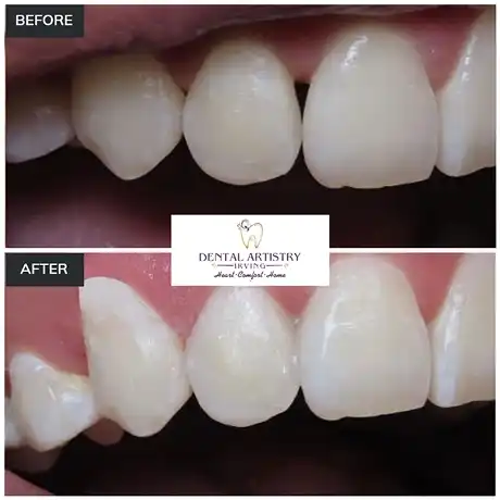 Before and after comparison showing results at Dental Artistry Irving