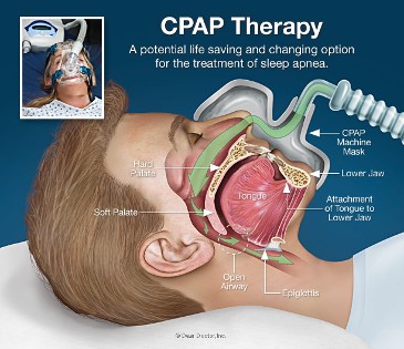 CPAP Therapy 