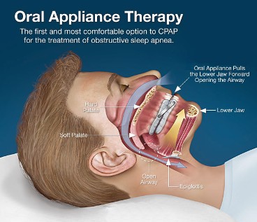 Oral Appliance therapy 