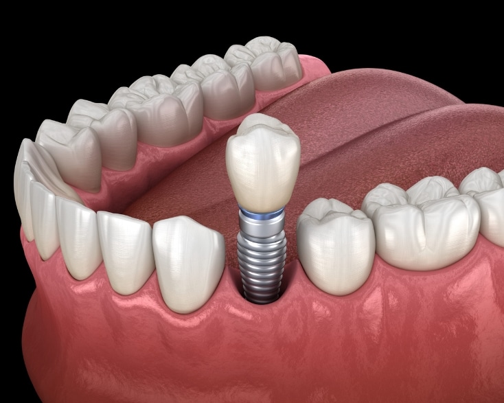 Featured image for “Are Dental Implants Noticeable?”