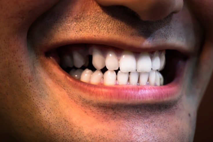 Teeth Whitening