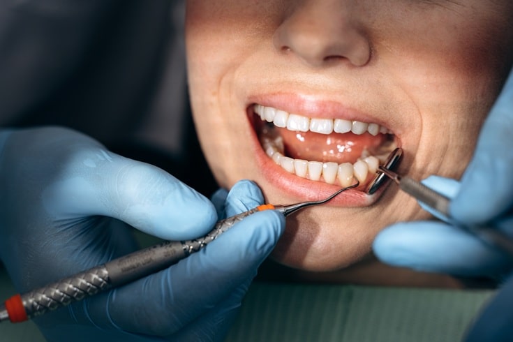 Wisdom Tooth Extractions