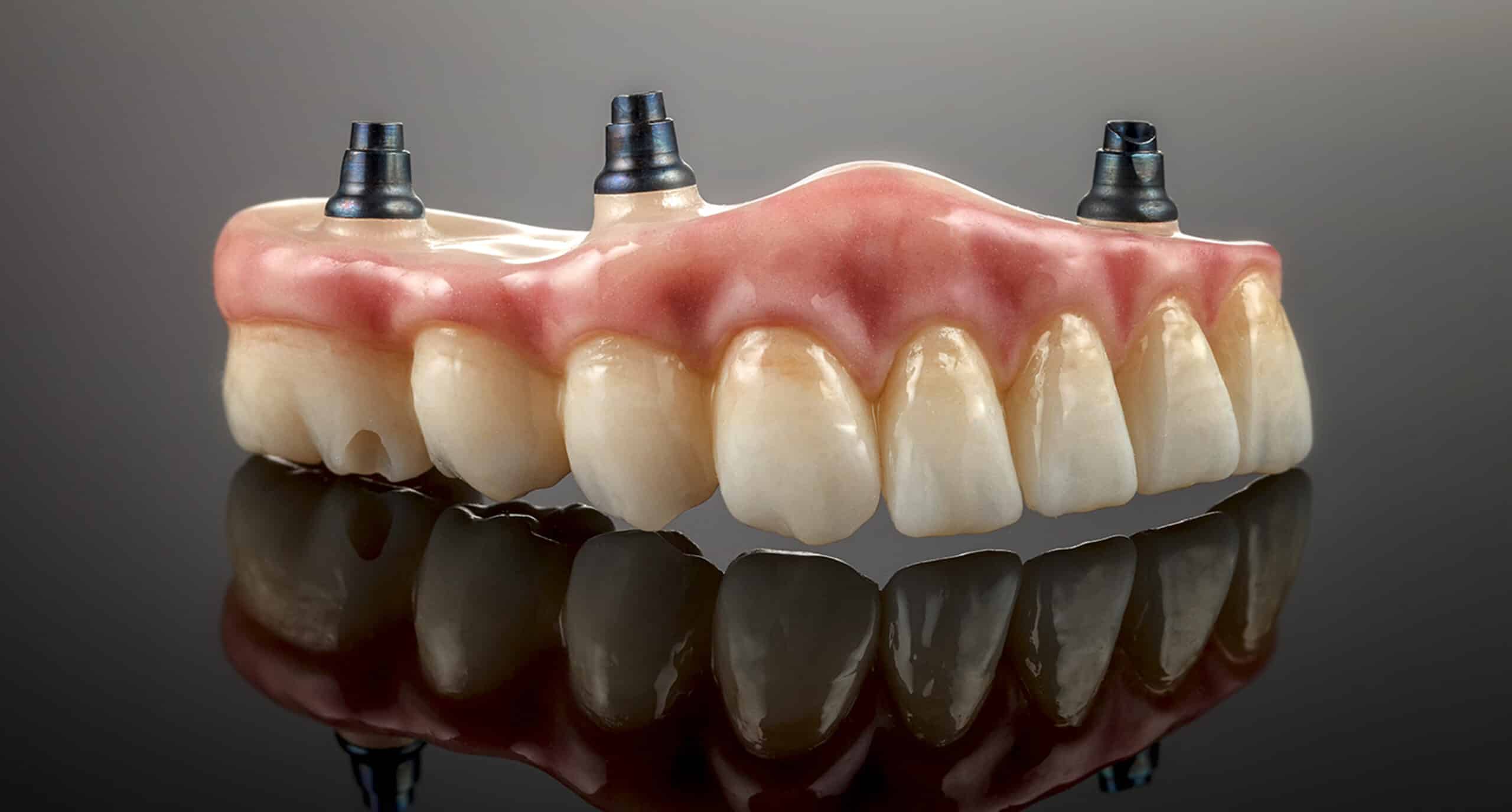 Implant-supported dentures