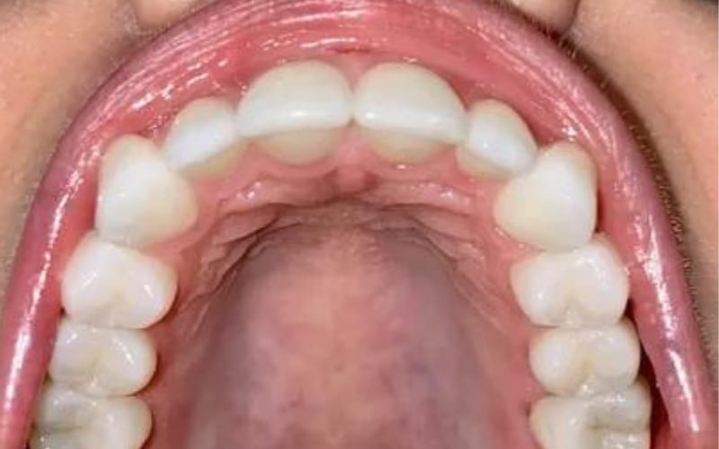 reasons for a lump on the roof of the mouth