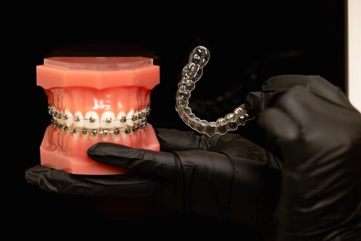 Invisalign Costs Compare to Traditional Braces