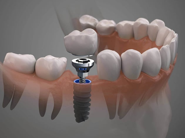 procedure for single tooth implants