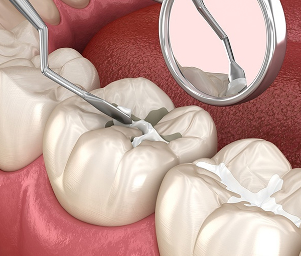 Dental sealants in kyle buda