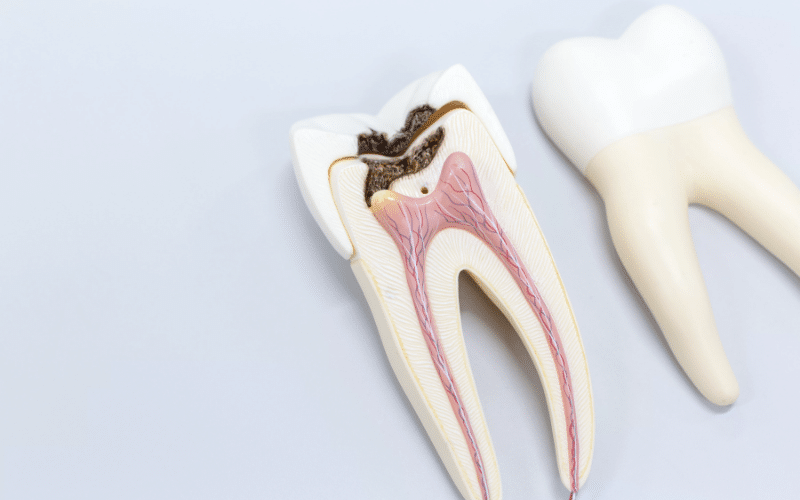 Root Canal Therapy in One Visit