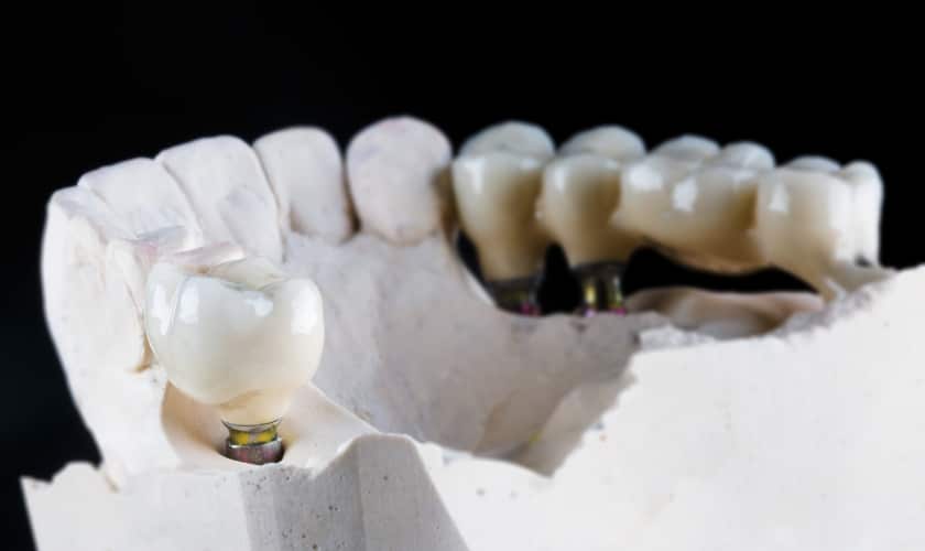 Dental Bridge in Manvel, TX, Manvel Dental & Implant Center
