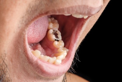 Amalgam Removal