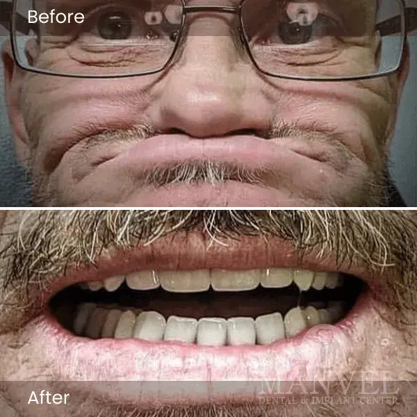 Before & After