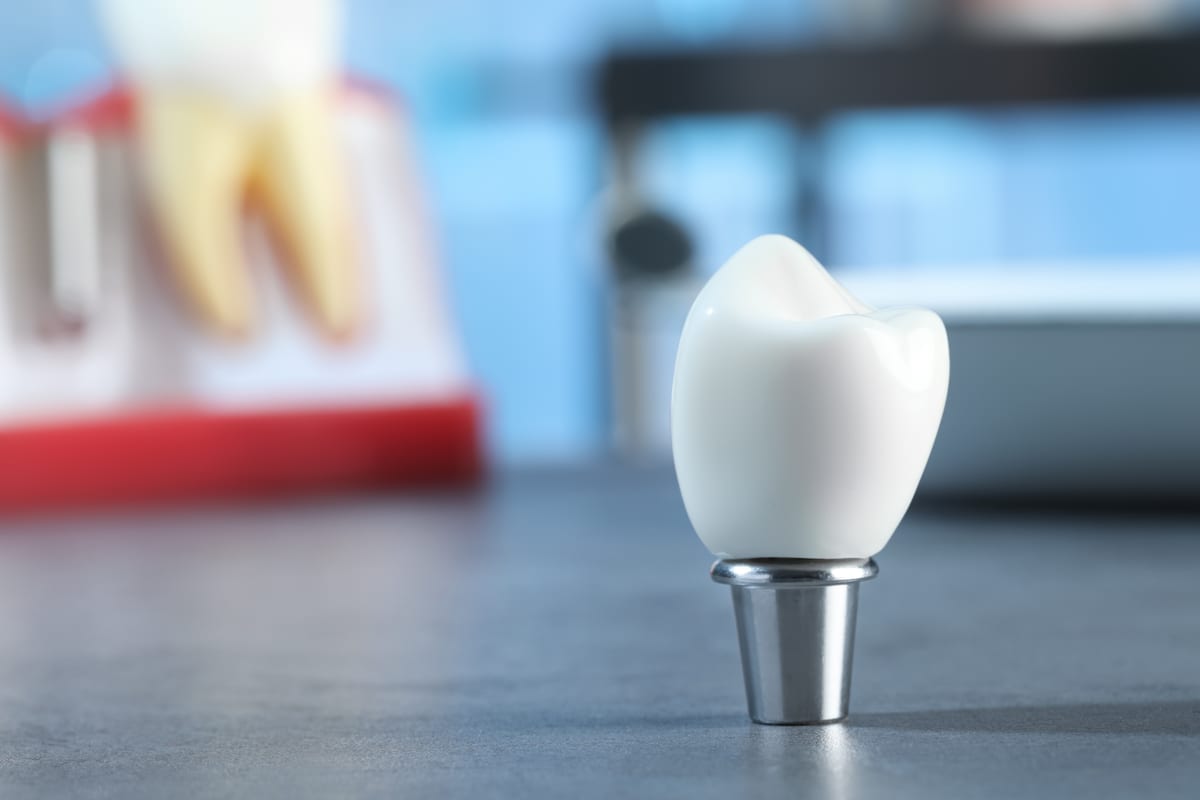 What to Expect After Your Dental Bridge: Recovery and Pain Management