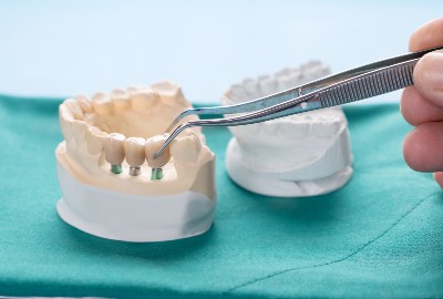 Dental Bridges