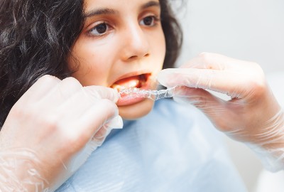 Fast Braces