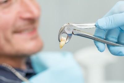 Tooth Extractions