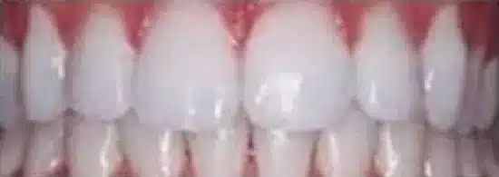 after smile makeover