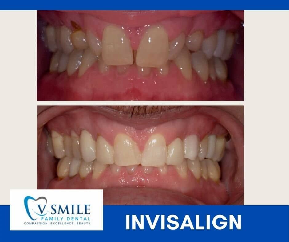 Before and after Invisalign treatment